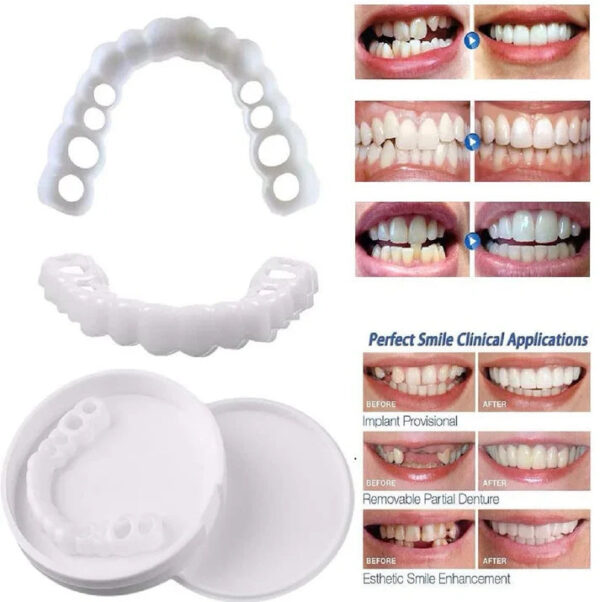 SnapOn Smile Dental Veneers - Image 5